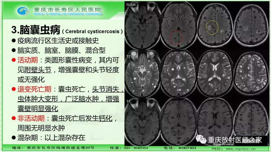 影像PPT - 【PPT】脑实质内囊性病变的MR诊断-49