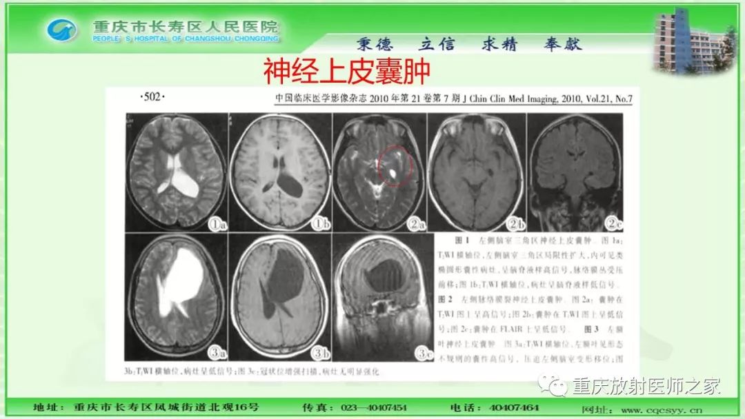 影像PPT - 【PPT】脑实质内囊性病变的MR诊断-52