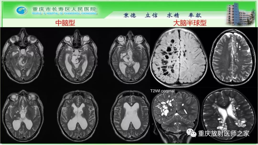 影像PPT - 【PPT】脑实质内囊性病变的MR诊断-54