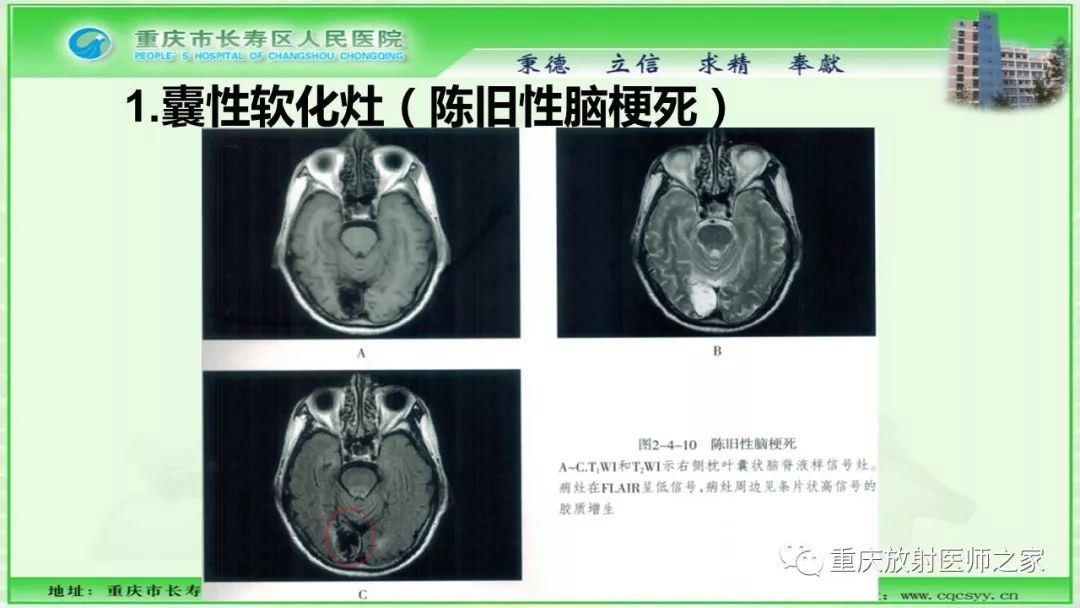 影像PPT - 【PPT】脑实质内囊性病变的MR诊断-56