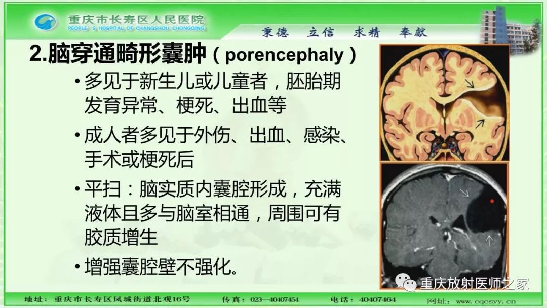 影像PPT - 【PPT】脑实质内囊性病变的MR诊断-57