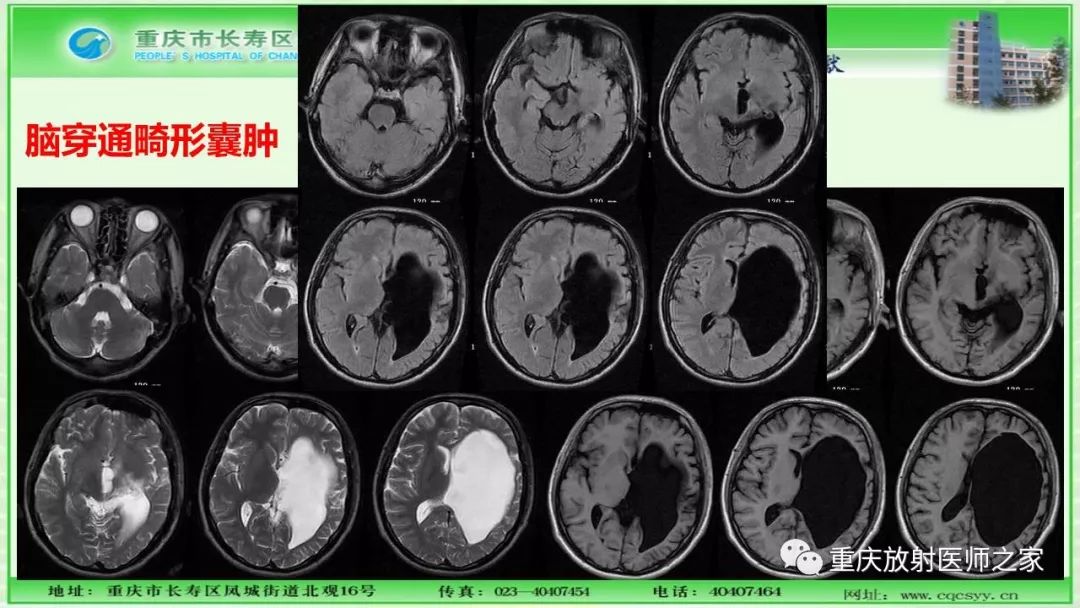 影像PPT - 【PPT】脑实质内囊性病变的MR诊断-58