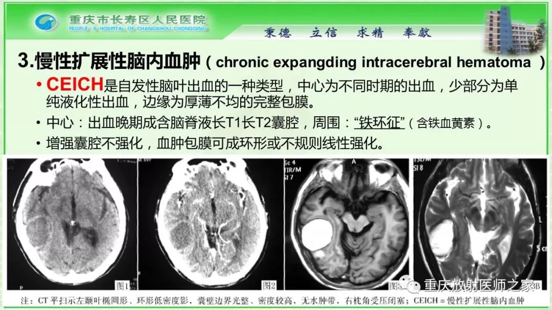 影像PPT - 【PPT】脑实质内囊性病变的MR诊断-59