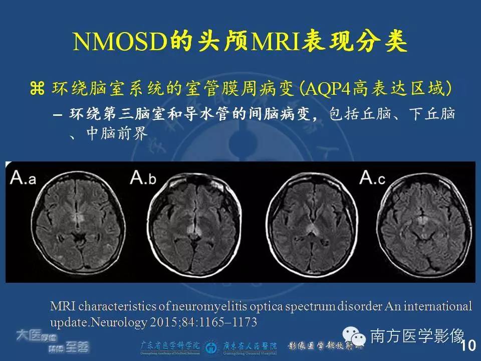 影像PPT - 【PPT】视神经脊髓炎谱系疾病的MRI特点-10