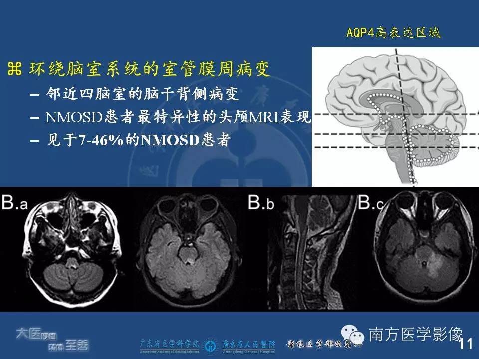 影像PPT - 【PPT】视神经脊髓炎谱系疾病的MRI特点-11