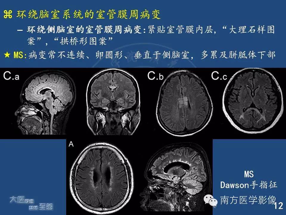 影像PPT - 【PPT】视神经脊髓炎谱系疾病的MRI特点-12