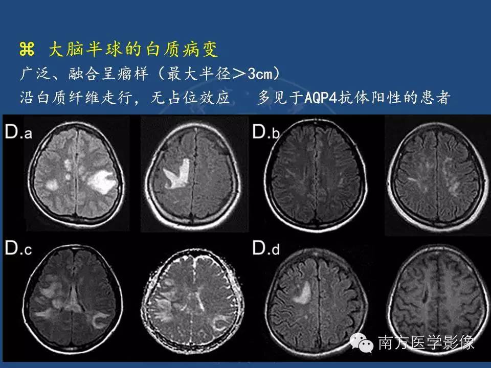 影像PPT - 【PPT】视神经脊髓炎谱系疾病的MRI特点-13