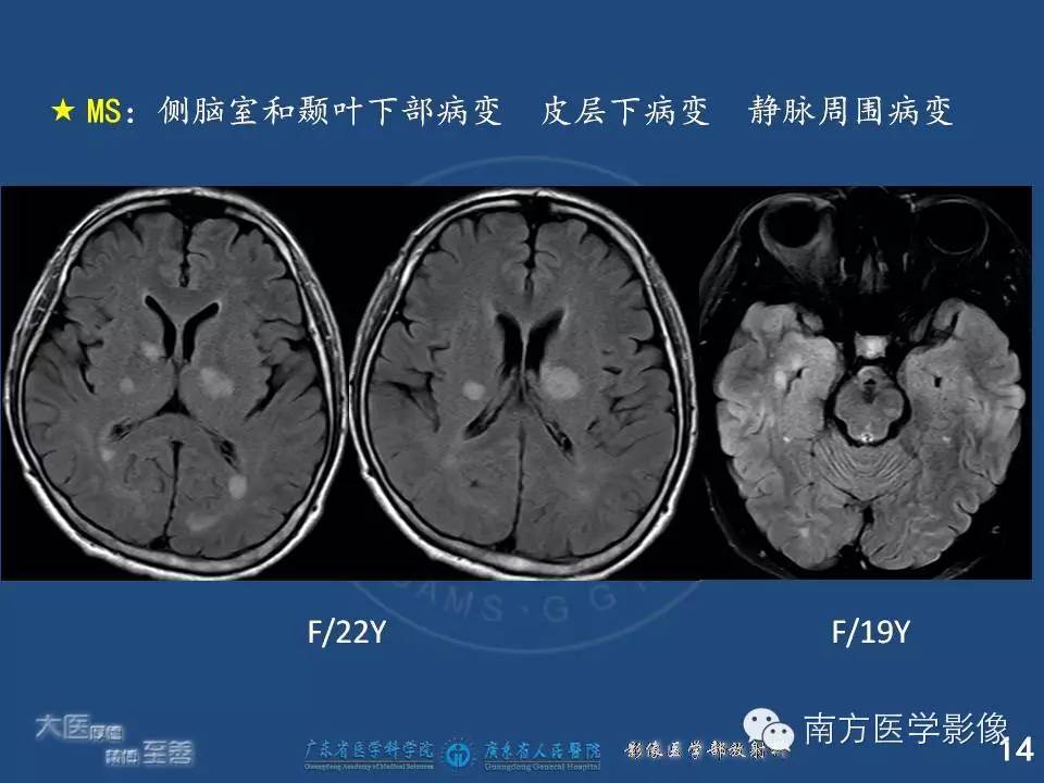 影像PPT - 【PPT】视神经脊髓炎谱系疾病的MRI特点-14