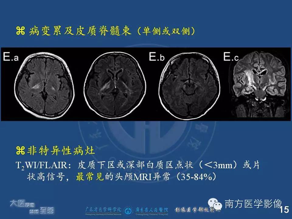 影像PPT - 【PPT】视神经脊髓炎谱系疾病的MRI特点-15