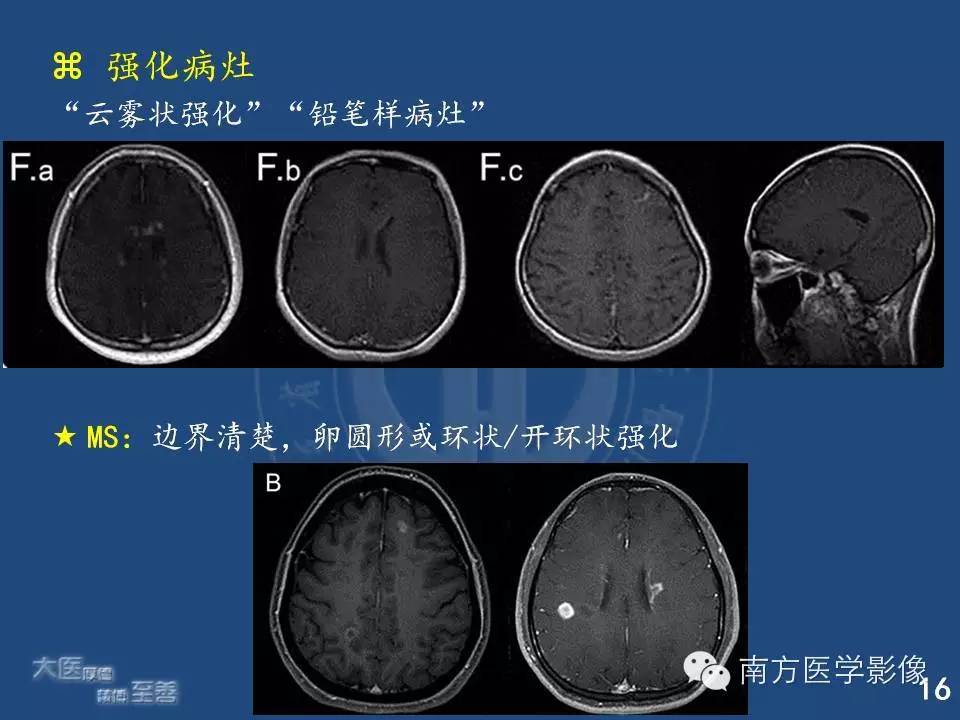 影像PPT - 【PPT】视神经脊髓炎谱系疾病的MRI特点-16