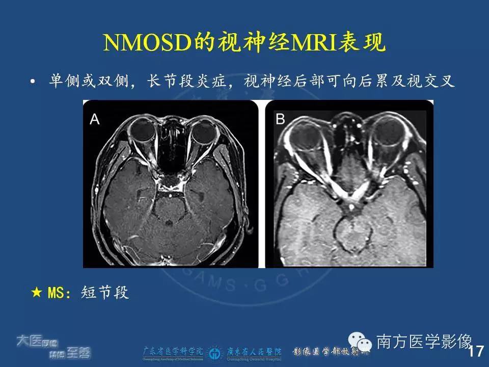 影像PPT - 【PPT】视神经脊髓炎谱系疾病的MRI特点-17