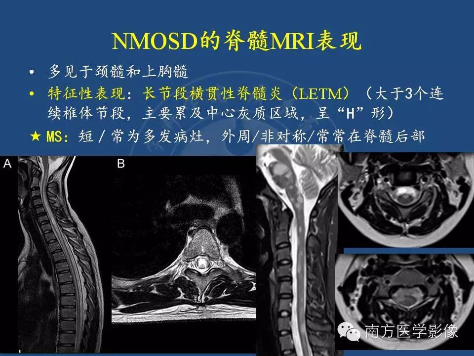 影像PPT - 【PPT】视神经脊髓炎谱系疾病的MRI特点-18