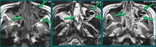影像PPT - 8种鼻部病变的影像鉴别诊断-3 影像PPT - 8种鼻部病变的影像鉴别诊断-3