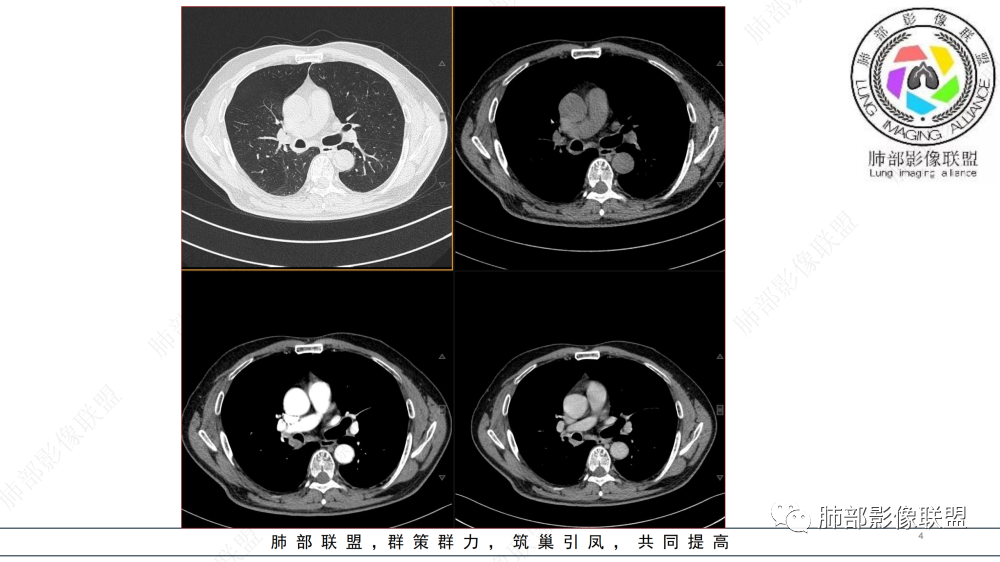 影像PPT - 【病例】管腔内病变1例CT诊断思路及易忽视的问题-4