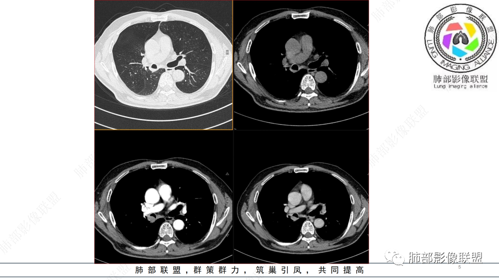 影像PPT - 【病例】管腔内病变1例CT诊断思路及易忽视的问题-5