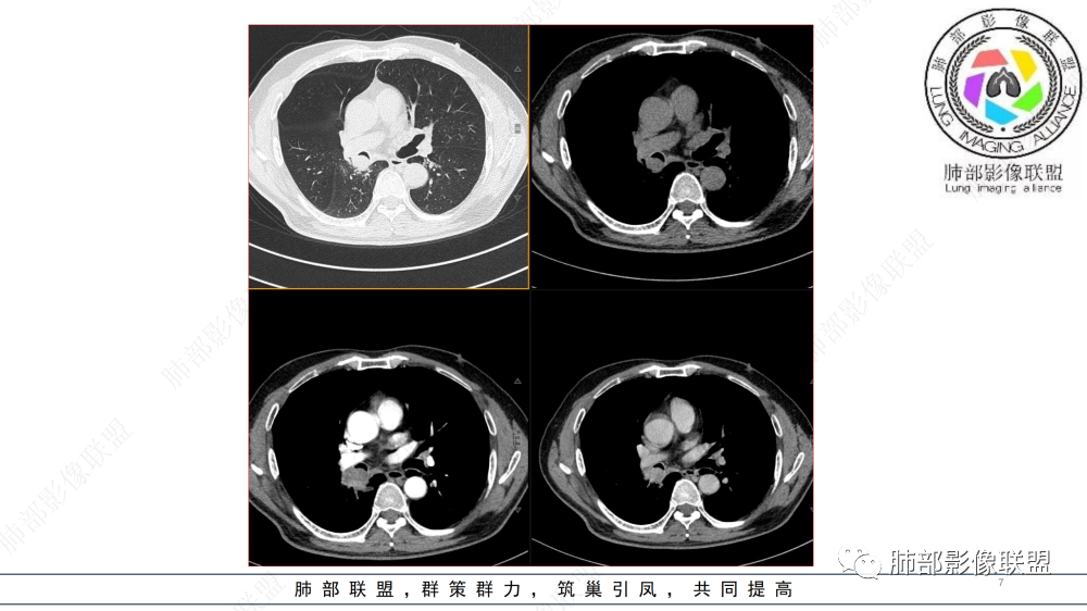 影像PPT - 【病例】管腔内病变1例CT诊断思路及易忽视的问题-7