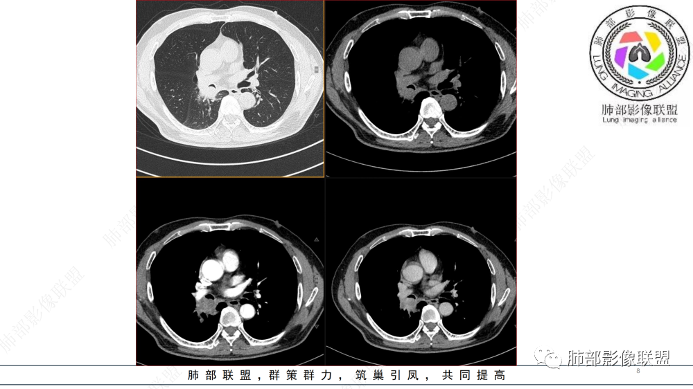 影像PPT - 【病例】管腔内病变1例CT诊断思路及易忽视的问题-8
