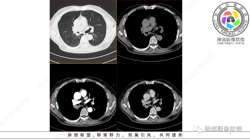 影像PPT - 【病例】管腔内病变1例CT诊断思路及易忽视的问题-6