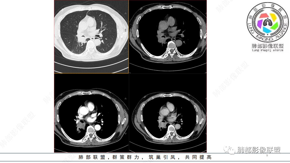 影像PPT - 【病例】管腔内病变1例CT诊断思路及易忽视的问题-9