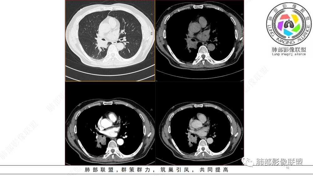 影像PPT - 【病例】管腔内病变1例CT诊断思路及易忽视的问题-10