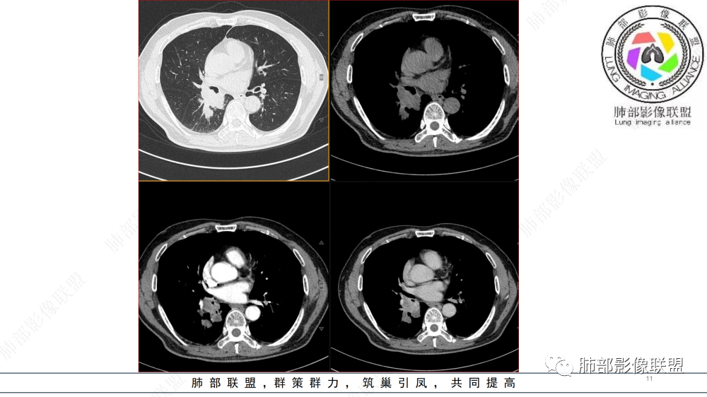 影像PPT - 【病例】管腔内病变1例CT诊断思路及易忽视的问题-11