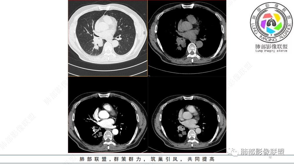 影像PPT - 【病例】管腔内病变1例CT诊断思路及易忽视的问题-12