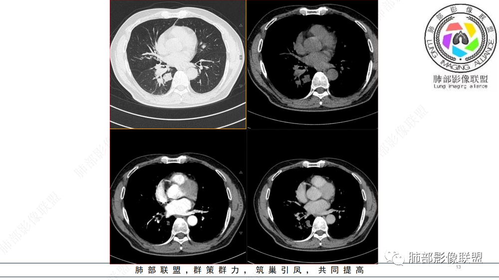影像PPT - 【病例】管腔内病变1例CT诊断思路及易忽视的问题-13
