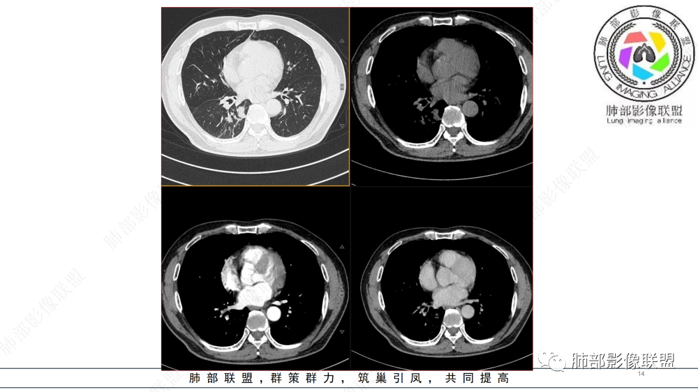 影像PPT - 【病例】管腔内病变1例CT诊断思路及易忽视的问题-14