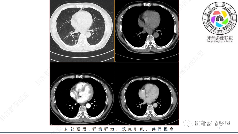 影像PPT - 【病例】管腔内病变1例CT诊断思路及易忽视的问题-15