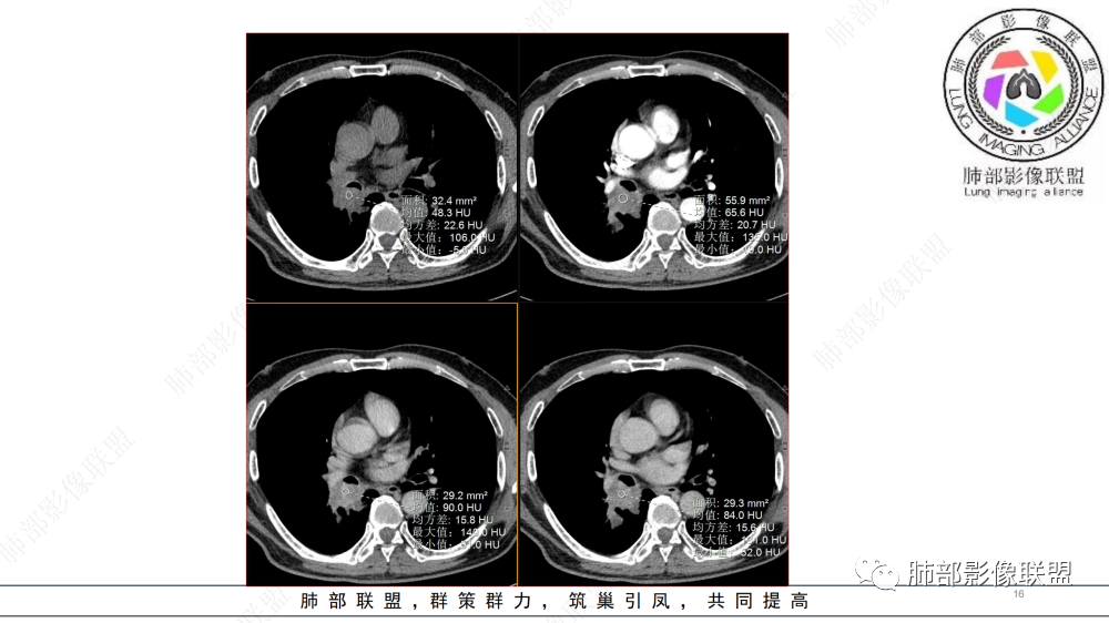 影像PPT - 【病例】管腔内病变1例CT诊断思路及易忽视的问题-16