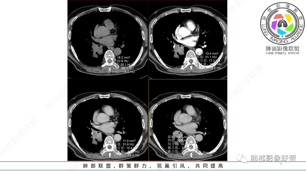 影像PPT - 【病例】管腔内病变1例CT诊断思路及易忽视的问题-17
