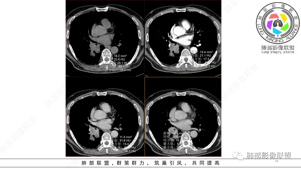 影像PPT - 【病例】管腔内病变1例CT诊断思路及易忽视的问题-18
