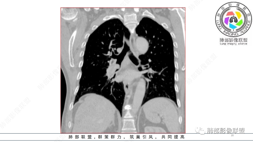 影像PPT - 【病例】管腔内病变1例CT诊断思路及易忽视的问题-20
