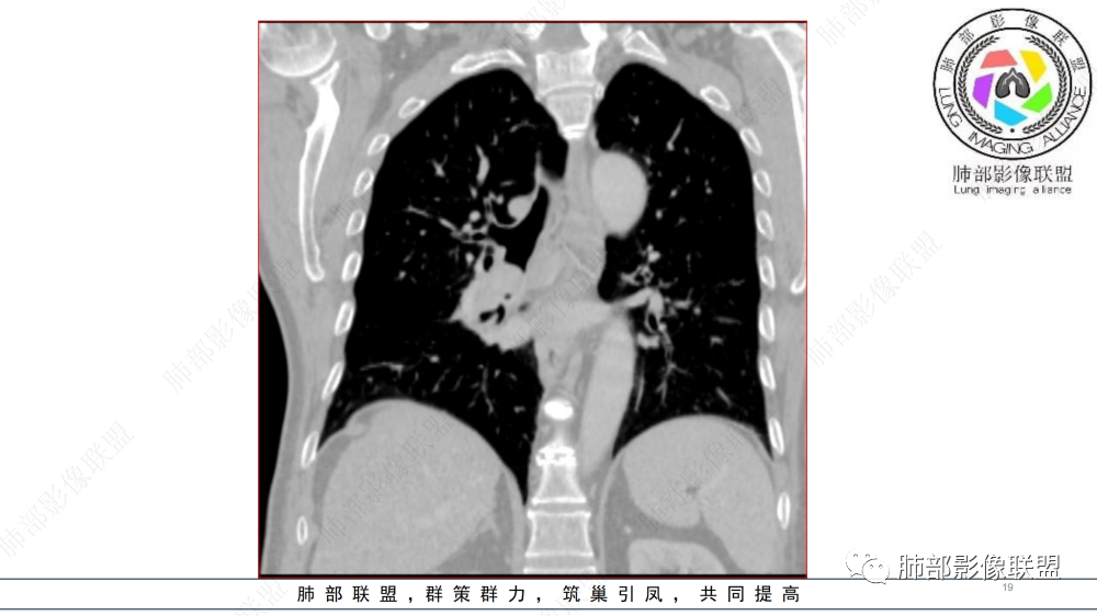 影像PPT - 【病例】管腔内病变1例CT诊断思路及易忽视的问题-19