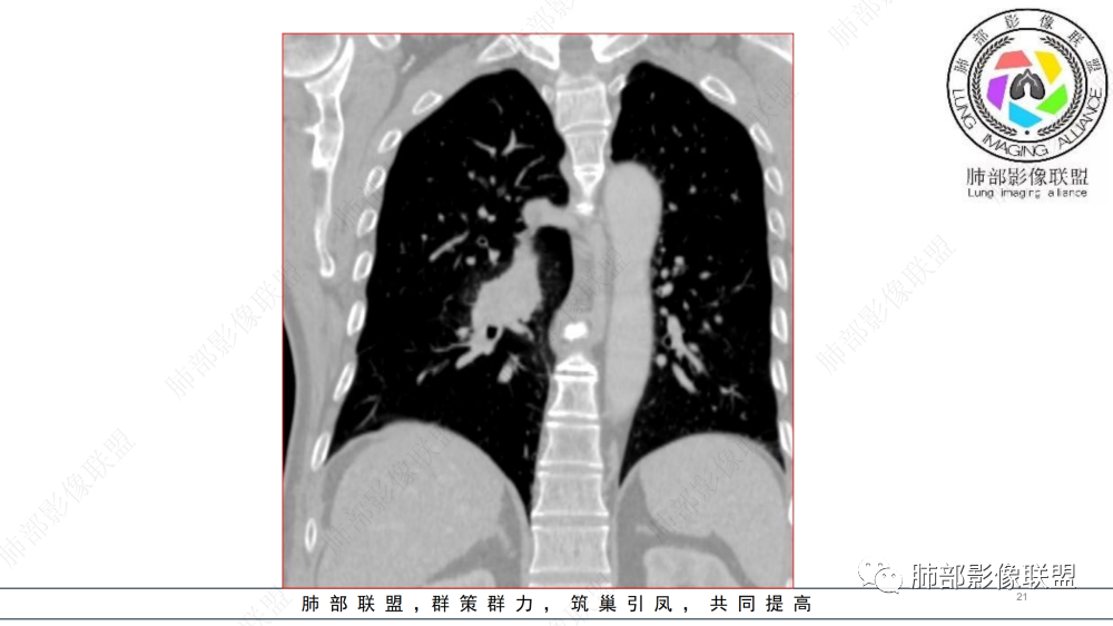 影像PPT - 【病例】管腔内病变1例CT诊断思路及易忽视的问题-21