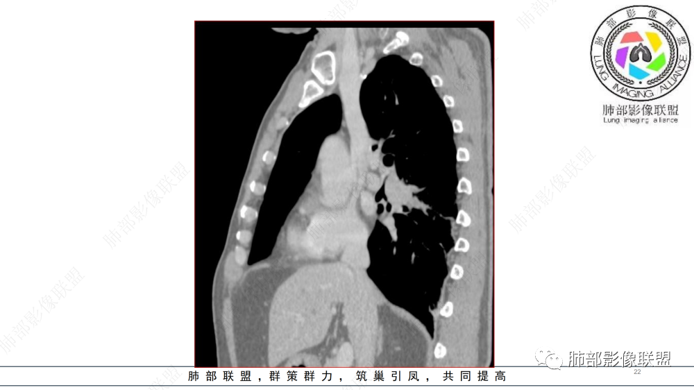 影像PPT - 【病例】管腔内病变1例CT诊断思路及易忽视的问题-22