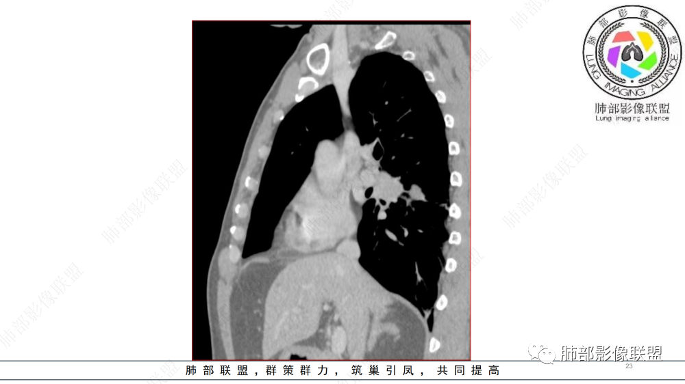 影像PPT - 【病例】管腔内病变1例CT诊断思路及易忽视的问题-23