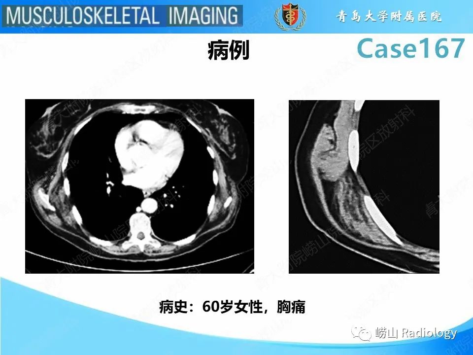 影像PPT - 【PPT】背部弹力纤维瘤-2