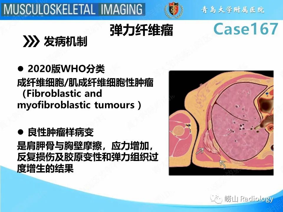 影像PPT - 【PPT】背部弹力纤维瘤-11