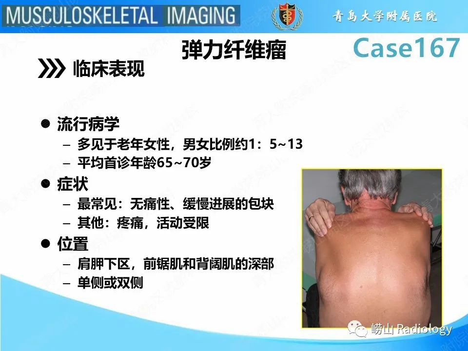 影像PPT - 【PPT】背部弹力纤维瘤-12