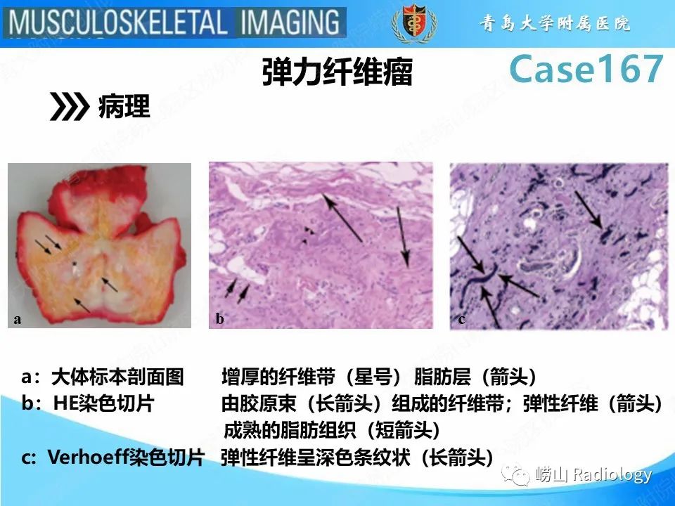 影像PPT - 【PPT】背部弹力纤维瘤-13