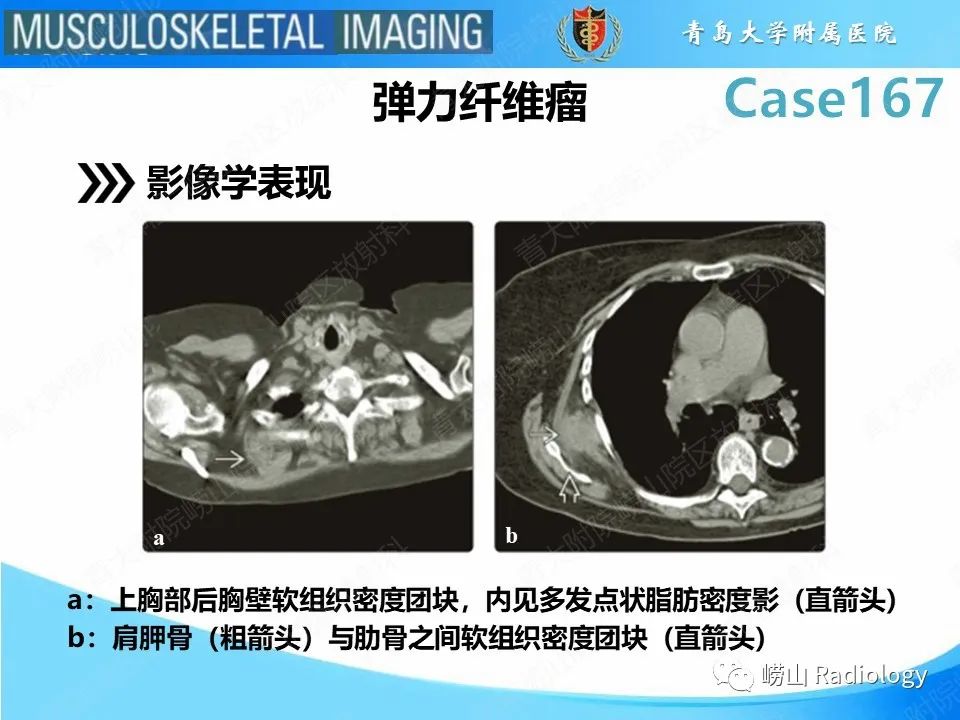 影像PPT - 【PPT】背部弹力纤维瘤-15