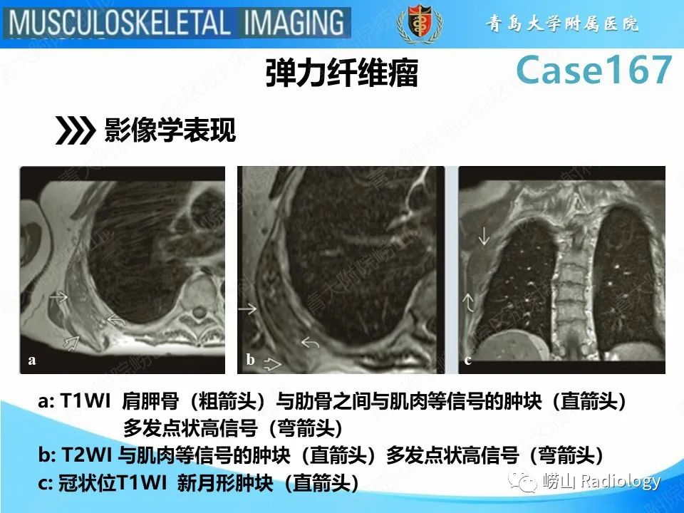 影像PPT - 【PPT】背部弹力纤维瘤-16