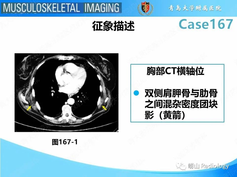 影像PPT - 【PPT】背部弹力纤维瘤-17