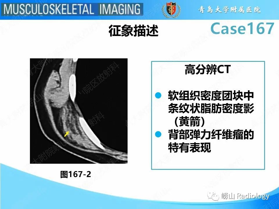 影像PPT - 【PPT】背部弹力纤维瘤-18