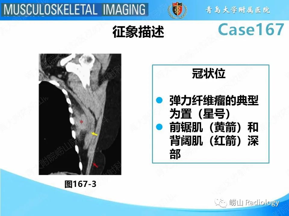 影像PPT - 【PPT】背部弹力纤维瘤-19