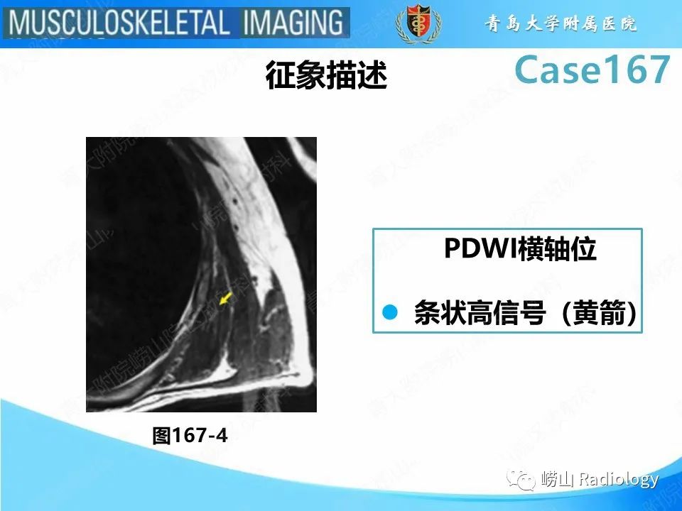 影像PPT - 【PPT】背部弹力纤维瘤-20