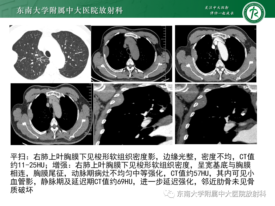 影像PPT - 【PPT】胸部孤立性纤维性肿瘤-3 影像PPT - 【PPT】胸部孤立性纤维性肿瘤-3