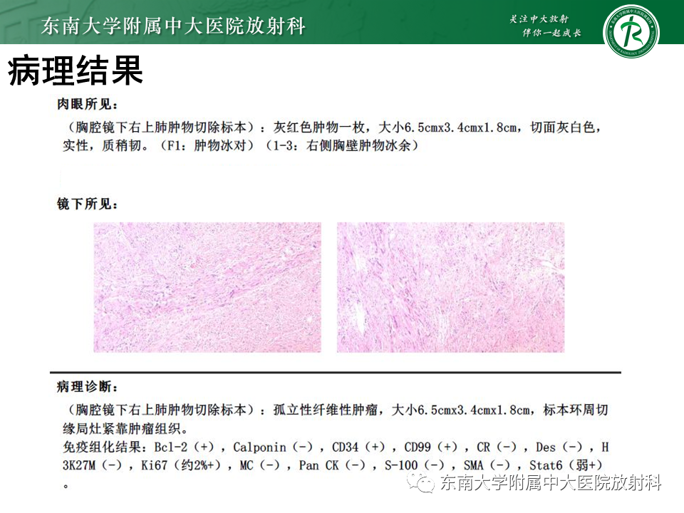 影像PPT - 【PPT】胸部孤立性纤维性肿瘤-4 影像PPT - 【PPT】胸部孤立性纤维性肿瘤-4
