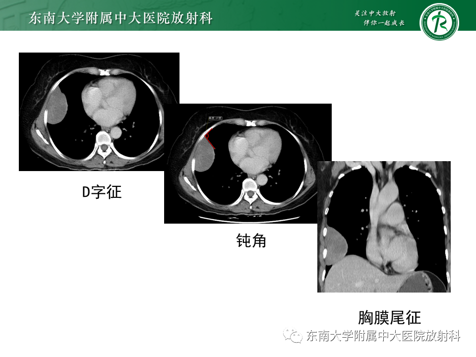 影像PPT - 【PPT】胸部孤立性纤维性肿瘤-16 影像PPT - 【PPT】胸部孤立性纤维性肿瘤-16